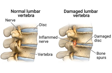Normal lumbar disc, nerve, and vertebra compared with damaged lumbar disc, inflamed nerve, and bone spurs.