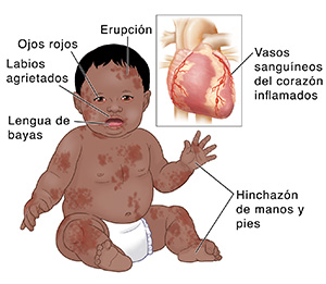 Vista frontal del bebé con erupción cutánea, ojos rojos, labios agrietados, lengua de bayas e hinchazón de manos y pies. Una imagen insertada muestra un corazón con vasos sanguíneos inflamados.